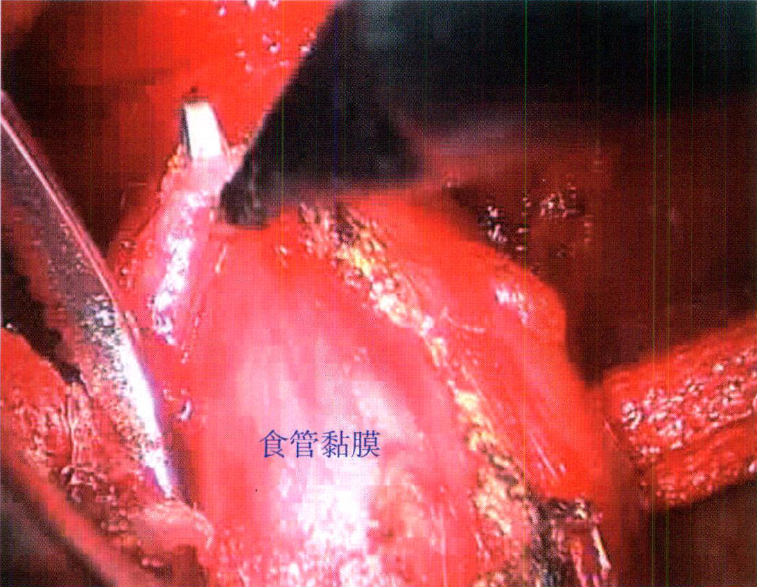 典型病例 賁門失弛緩癥
